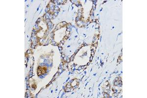 Immunohistochemistry of paraffin-embedded Human thyroid cancer using CYP51 Rabbit pAb (3485) at dilution of 1:50 (40x lens). (CYP51A1 anticorps  (AA 210-509))