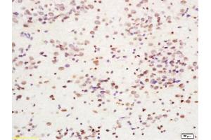 Formalin-fixed and paraffin embedded human glima labeled with Anti-Cdc7 Polyclonal Antibody, Unconjugated (ABIN755557) at 1:200 followed by conjugation to the secondary antibody and DAB staining. (CDC7 anticorps  (AA 151-250))