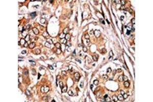 IHC analysis of FFPE human breast carcinoma tissue stained with the phospho-Rb antibody. (Retinoblastoma Protein (Rb) anticorps  (pSer780))