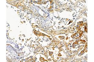 ABIN7095732 and ABIN7099794 at 1/100 staining human pancreatic cancer by IHC-P. (KCNIP2 anticorps)