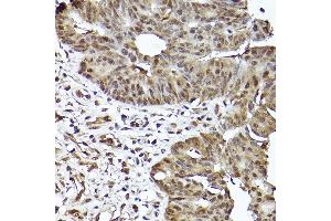 Immunohistochemistry of paraffin-embedded human colon carcinoma using [KO Validated] ST Rabbit mAb (ABIN7270305) at dilution of 1:100 (40x lens). (STAT3 anticorps)