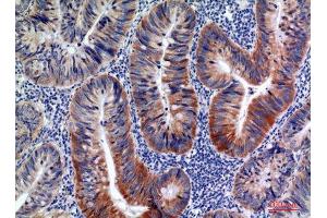 Immunohistochemistry (IHC) analysis of paraffin-embedded Human Colon Cancer, antibody was diluted at 1:100.