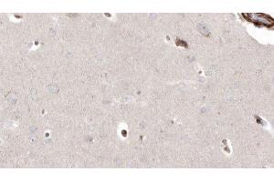 ABIN6272927 at 1/100 staining Human brain cancer tissue by IHC-P. (PIEZO1 anticorps  (Internal Region))