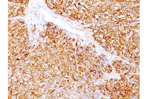 Formalin-fixed, paraffin-embedded human Melanoma stained with Melanoma Marker Mouse Monoclonal Antibody (DT101+ BC199 + HMB45). (MLANA & SILV anticorps)