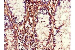 Immunohistochemistry of paraffin-embedded human colon cancer using ABIN7155925 at dilution of 1:100 (CDC37 anticorps  (AA 89-175))