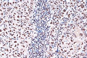 Immunohistochemistry of paraffin-embedded human esophageal cancer using KHSRP Rabbit mAb (ABIN7268110) at dilution of 1:100 (40x lens).