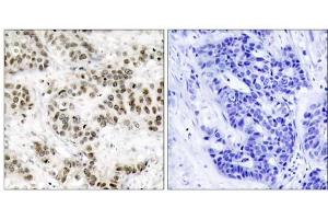 Immunohistochemical analysis of paraffin-embedded human breast carcinoma tissue using SAPK/JNK (Ab-185) antibody (E021242). (SAPK, JNK anticorps)