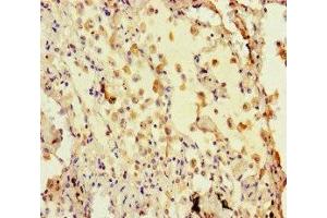 Immunohistochemistry of paraffin-embedded human lung cancer using ABIN7155425 at dilution of 1: 100 (Histone 3 anticorps  (AA 2-30))