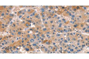 Immunohistochemistry of paraffin-embedded Human liver cancer tissue using ALOX15 Polyclonal Antibody at dilution 1:50