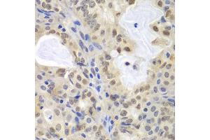 Immunohistochemistry of paraffin-embedded human oophoroma using MCM3 antibody at dilution of 1:100 (400x lens). (MCM3 anticorps)
