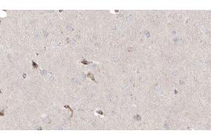 ABIN6272925 at 1/100 staining Human brain cancer tissue by IHC-P.