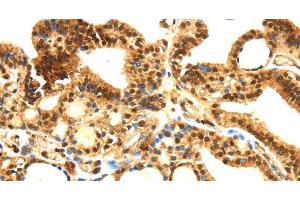 Immunohistochemistry of paraffin-embedded Human thyroid cancer tissue using SERPINB1 Polyclonal Antibody at dilution 1:30 (SERPINB1 anticorps)