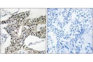 Immunohistochemistry analysis of paraffin-embedded human breast carcinoma tissue, using ARSK Antibody. (Arylsulfatase K anticorps  (AA 481-530))