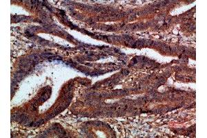 Immunohistochemical analysis of paraffin-embedded human-colon-cancer, antibody was diluted at 1:200 (CTNND1 anticorps)