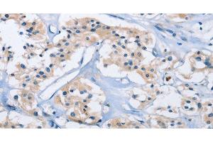 Immunohistochemistry of paraffin-embedded Human thyroid cancer using CARD14 Polyclonal Antibody at dilution of 1:30 (CARD14 anticorps)