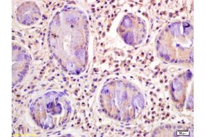 Formalin-fixed and paraffin embedded human gastric carcinoma labeled with Rabbit Anti CD33/Siglec-3 Polyclonal Antibody, Unconjugated (ABIN676958) at 1:200 followed by conjugation to the secondary antibody and DAB staining