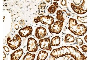 ABIN6260614 and ABIN6277051 at 1/100 staining Human kidney cancer and adjacent normal tissues by IHC-P.