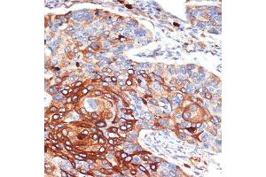Immunohistochemistry of paraffin-embedded human esophageal cancer using ORM1/2 Rabbit mAb (ABIN7269114) at dilution of 1:100 (40x lens). (Orosomucoid 2 anticorps)