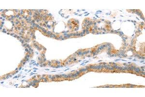 Immunohistochemistry of paraffin-embedded Human thyroid cancer using TNIP2 Polyclonal Antibody at dilution of 1:35