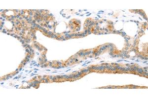 Immunohistochemistry of paraffin-embedded Human thyroid cancer using TNIP2 Polyclonal Antibody at dilution of 1:35 (TNIP2 anticorps)