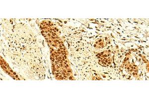 Immunohistochemistry of paraffin-embedded Human esophagus cancer tissue using UNKL Polyclonal Antibody at dilution of 1:50(x200) (UNKL anticorps)
