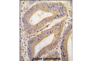 Formalin-fixed and paraffin-embedded human colon carcinoma tissue reacted with PHB2 polyclonal antibody  , which was peroxidase-conjugated to the secondary antibody, followed by DAB staining. (Prohibitin 2 anticorps  (N-Term))