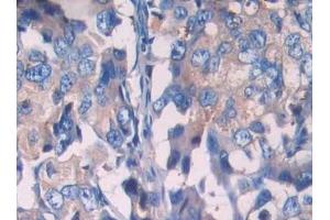 Detection of SIGIRR in Human Breast cancer Tissue using Polyclonal Antibody to Single Ig IL1 Related Receptor (SIGIRR)