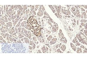 Immunohistochemistry of paraffin-embedded Human stomach cancer tissue using Cleaved-CASP3 p17 (D175) Polyclonal Antibody at dilution of 1:200.