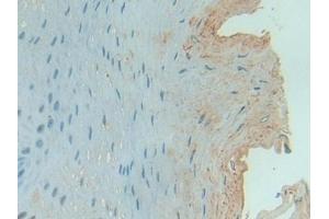 Detection of C1INH in Human Esophagus cancer Tissue using Polyclonal Antibody to Complement 1 Inhibitor (C1INH)