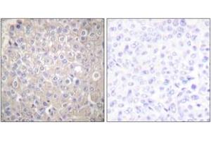 Immunohistochemistry analysis of paraffin-embedded human breast carcinoma tissue, using E-cadherin Antibody.