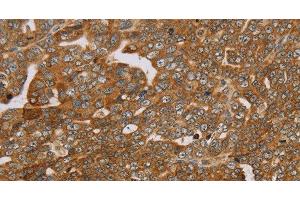 Immunohistochemistry of paraffin-embedded Human cervical cancer using PLEKHG6 Polyclonal Antibody at dilution of 1:45 (PLEKHG6 anticorps)