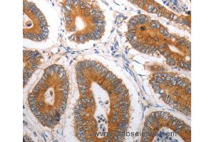 Immunohistochemistry of Human liver cancer using SLC12A6 Polyclonal Antibody at dilution of 1:40 (SLC12A6 anticorps)