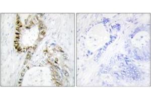 Immunohistochemistry analysis of paraffin-embedded human colon carcinoma, using FANCA (Ab-1149) Antibody.