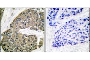 Immunohistochemistry analysis of paraffin-embedded human breast carcinoma tissue, using Keratin 5 Antibody. (Cytokeratin 5 anticorps  (AA 541-590))