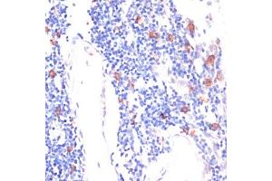 Immunohistochemistry of paraffin-embedded human lung cancer using WNT5B antibody (ABIN6130798, ABIN6150250, ABIN6150251 and ABIN6224330) at dilution of 1:100 (40x lens).