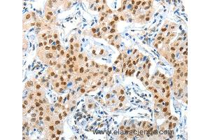 Immunohistochemistry of Human lung cancer using APPL1 Polyclonal Antibody at dilution of 1:70 (APPL1 anticorps)