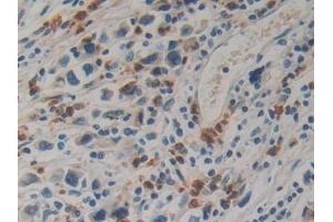 Detection of KLK10 in Human Stomach cancer Tissue using Polyclonal Antibody to Kallikrein 10 (KLK10)