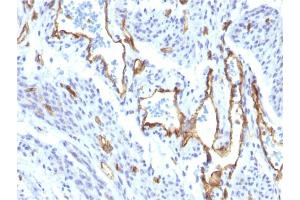 Formalin-fixed, paraffin-embedded human Angiosarcoma stained with CD31-Monospecific Recombinant Rabbit Monoclonal Antibody (C31/1395R).