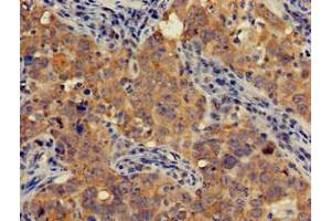 Immunohistochemistry of paraffin-embedded human pancreatic cancer using ABIN7143258 at dilution of 1:100