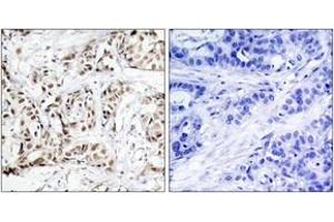Immunohistochemistry analysis of paraffin-embedded human breast carcinoma, using SAPK/JNK (Phospho-Thr183) Antibody. (SAPK, JNK (AA 151-200), (pThr183) anticorps)