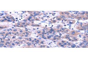 Immunohistochemistry of paraffin-embedded Human liver cancer using TRIM49 Polyclonal Antibody at dilution of 1/40 (TRIM49 anticorps)