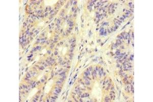 Immunohistochemistry of paraffin-embedded human colon cancer using ABIN7159762 at dilution of 1:100