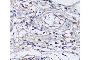 Immunohistochemistry of paraffin-embedded Human gastric cancer using NLRC4 Polyclonal Antibody at dilution of 1:100 (40x lens).
