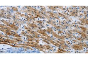 Immunohistochemistry of paraffin-embedded Human liver cancer tissue using PSMD11 Polyclonal Antibody at dilution 1:50 (PSMD11 anticorps)