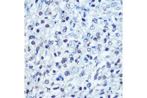 Immunohistochemistry of paraffin-embedded human liver cancer using [KO Validated] S Rabbit pAb (ABIN6132834, ABIN6147368, ABIN6147369 and ABIN7101817) at dilution of 1:100 (40x lens). (SAMHD1 anticorps  (AA 387-626))