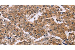 Immunohistochemistry of paraffin-embedded Human liver cancer using EPDR1 Polyclonal Antibody at dilution of 1:40