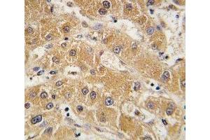 IHC analysis of FFPE human hepatocarcinoma tissue stained with APOA5 antibody