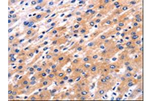 The image on the left is immunohistochemistry of paraffin-embedded Human liver cancer tissue using ABIN7192110(RAB39A Antibody) at dilution 1/5, on the right is treated with synthetic peptide. (RAB39A anticorps)