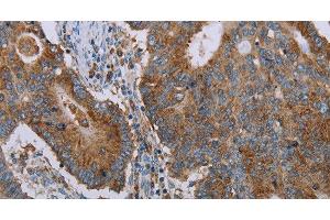 Immunohistochemistry of paraffin-embedded Human thyroid cancer tissue using CYP7A1 Polyclonal Antibody at dilution 1:30