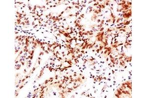 IHC testing of ovarian cancer stained with Estrogen Receptor beta antibody (ERb455). (ESR2 anticorps  (C-Term))